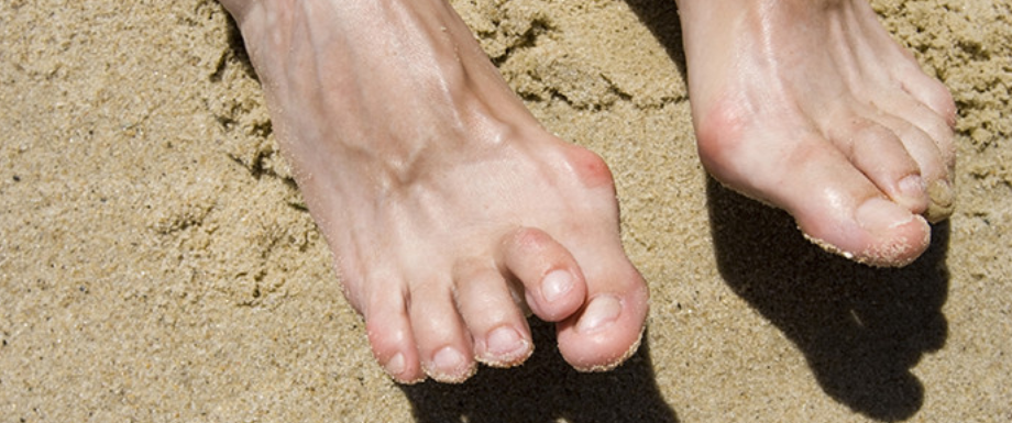 Diabetes and feet – Diagnosis of Bunions